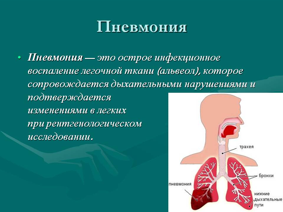 Пневмония