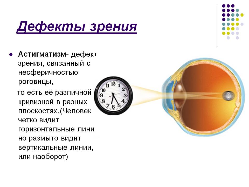 Дефекты зрения