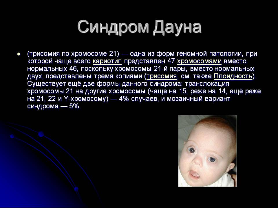 Синдром Дауна