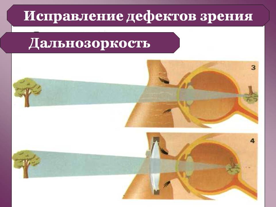 Дальнозоркость