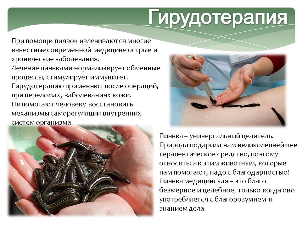Гирудотерапия