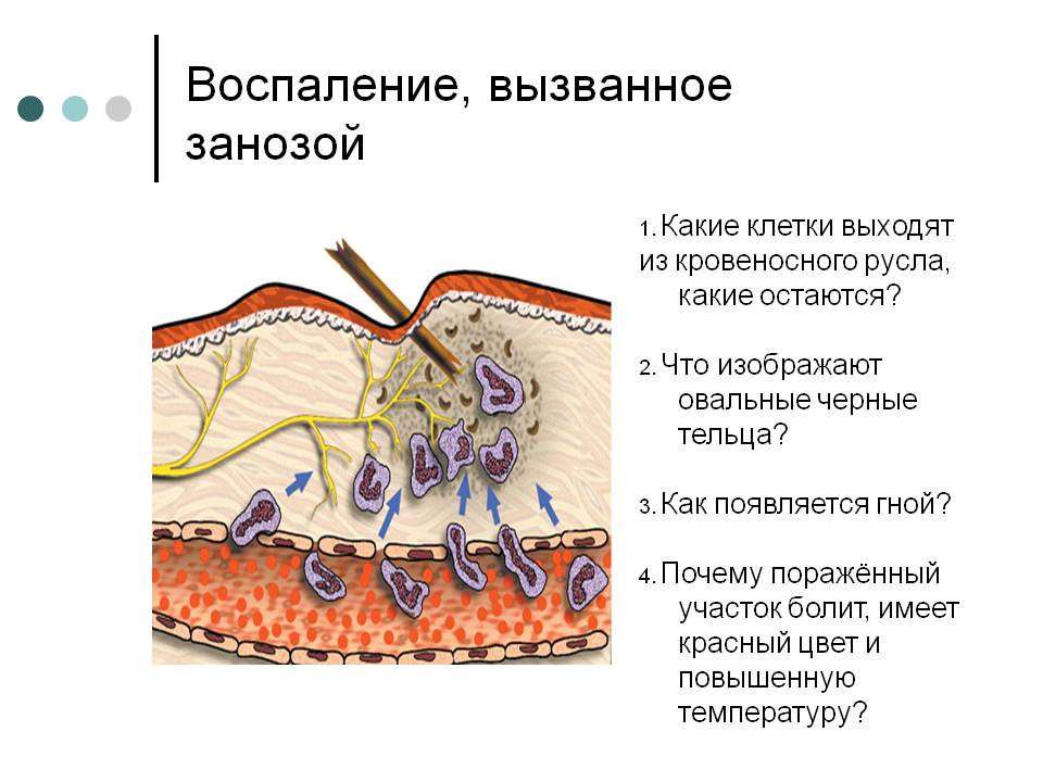 Воспаление, вызванное занозой