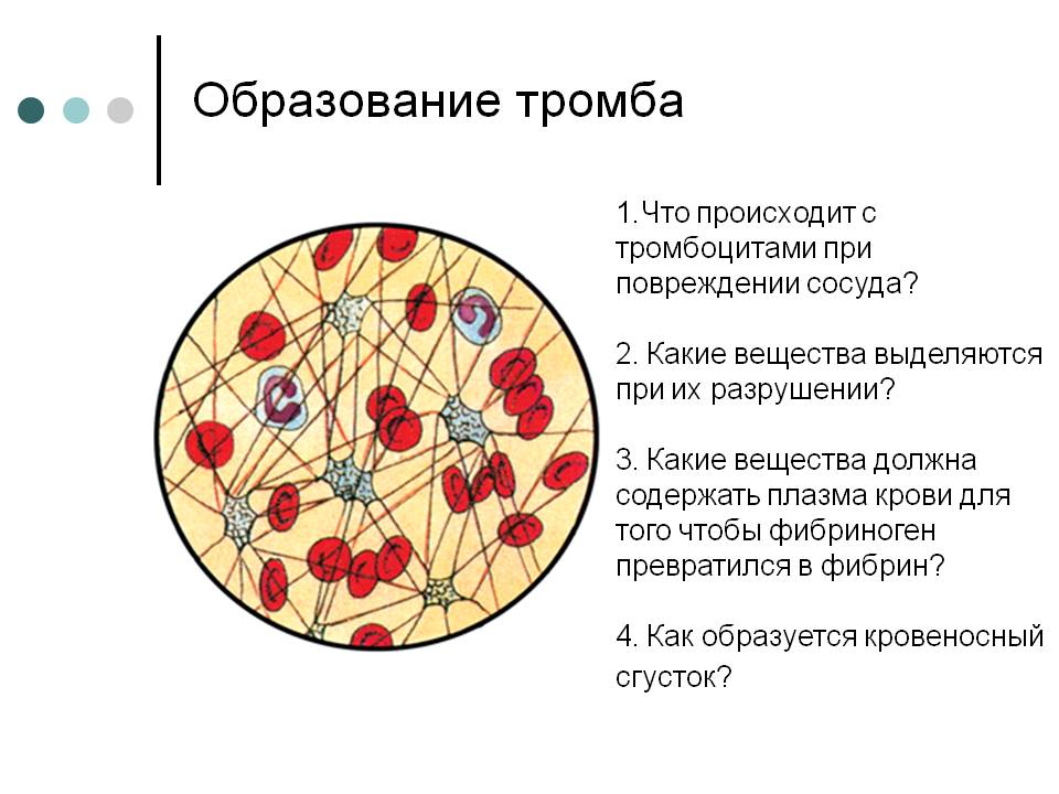 Образование тромба