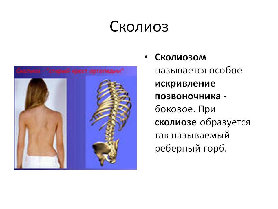 Сколиоз