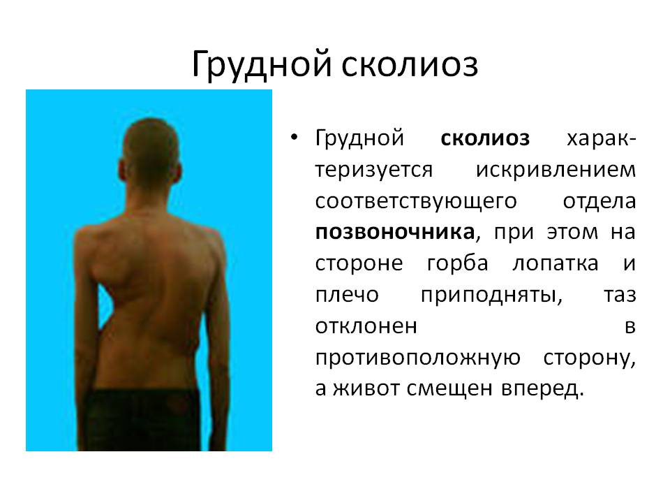 Грудной сколиоз