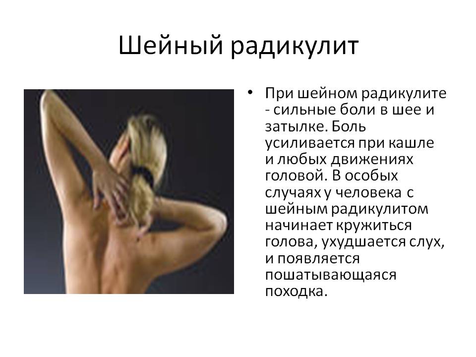 Шейный радикулит