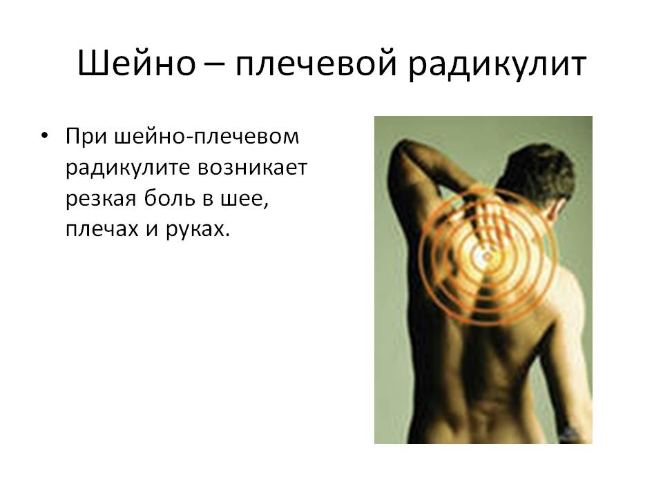 Плечевой радикулит