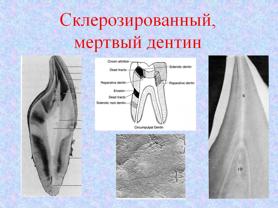 Склерозированный, мертвый дентин