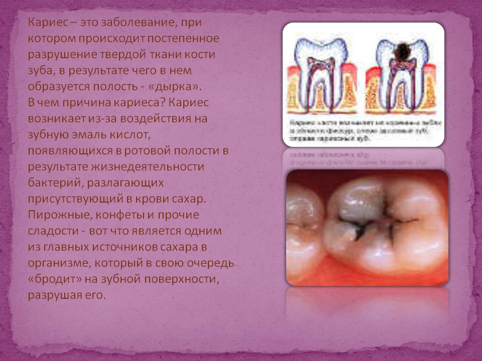 Кариес