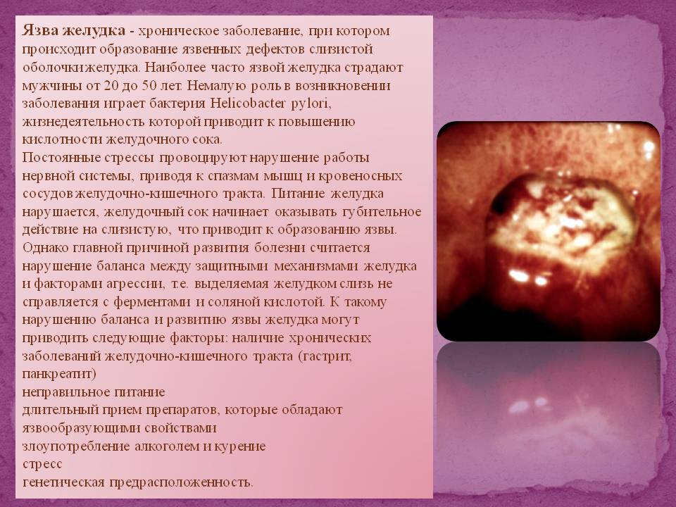 Язва желудка - хроническое заболевание