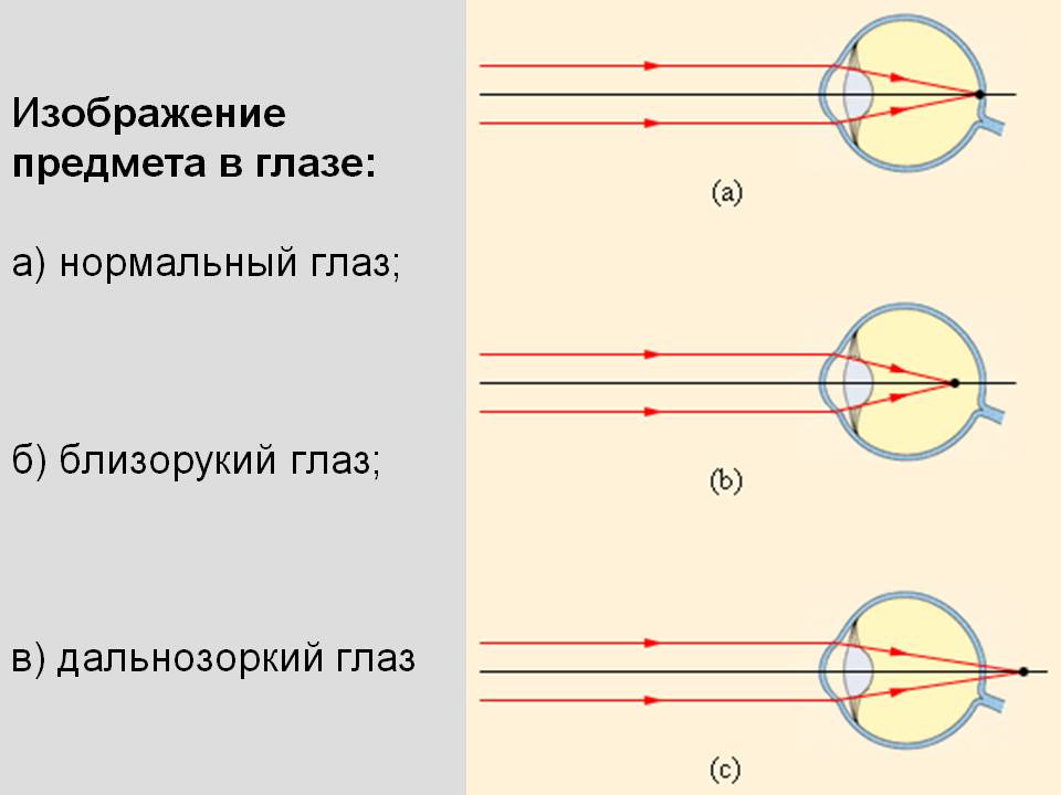 Изображение предмета в глазе: а) нормальный глаз; б) близорукий глаз;