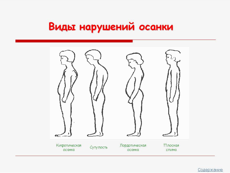 Виды нарушений осанки