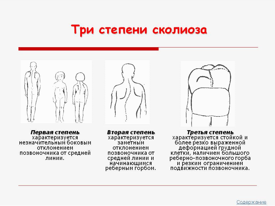 Три степени сколиоза