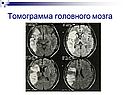 Томограмма головного мозга