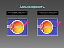 Преломление лучей света при дальнозоркости