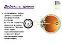 Дефекты зрения
