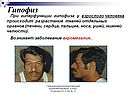 Разрастание тканей