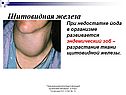 Эндемический зоб
