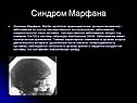 Синдром Марфана