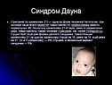 Синдром Дауна