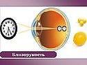 Близорукость
