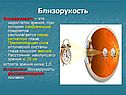 Близорукость