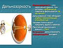 Дальнозоркость