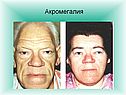 Акромегалия