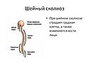 Шейный сколиоз