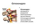 Остеохондроз