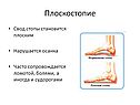 Плоскостопие