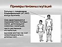 Больные с синдромом Клайнфельтера