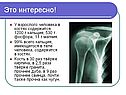 Переломы костей