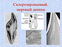 Склерозированный, мертвый дентин