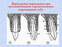 Перестройка периодонта при ортодонтическом горизонтальном перемещении