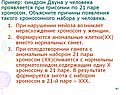 Синдром Дауна