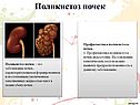 Поликистоз почек