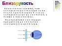 Близорукость